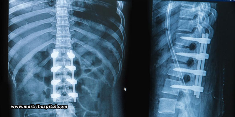 Do You Need Spinal Fusion Surgery To Treat Your Back Pain?