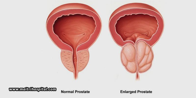 The-Facts-And-Myths-About-Enlarged-Prostates
